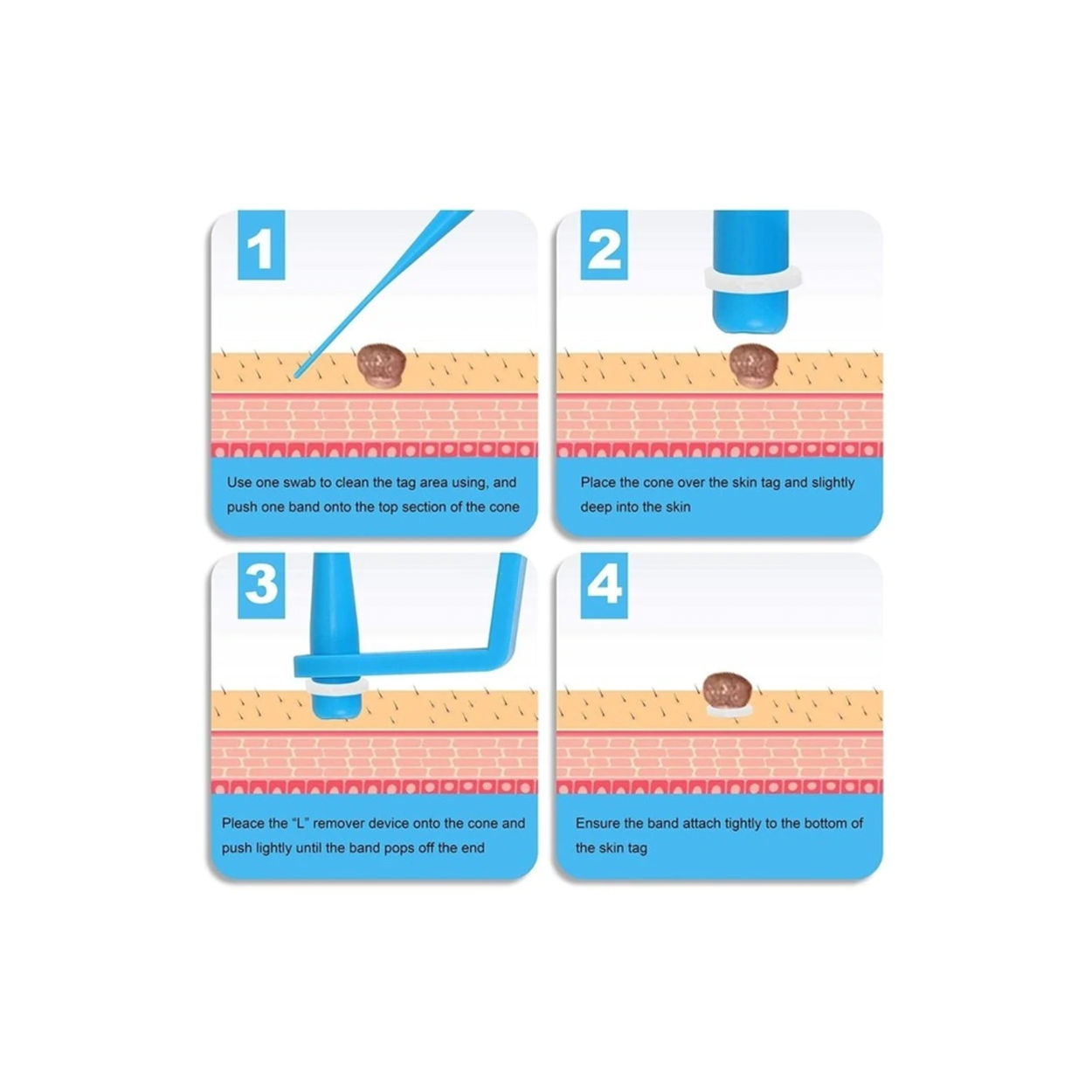 Micro Band Skin Tag Remover